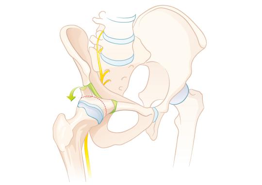 Periacetubare Osteotomie