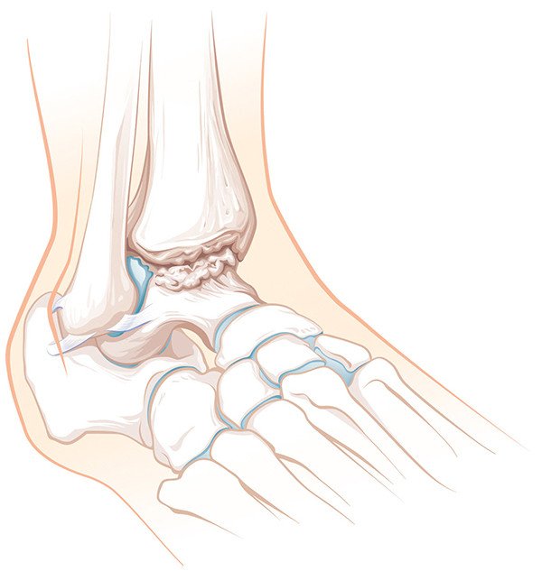 Arthrose des Sprunggelenks