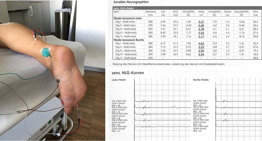 Ultraschall-unterstützten Positionierung der Ableitnadeln