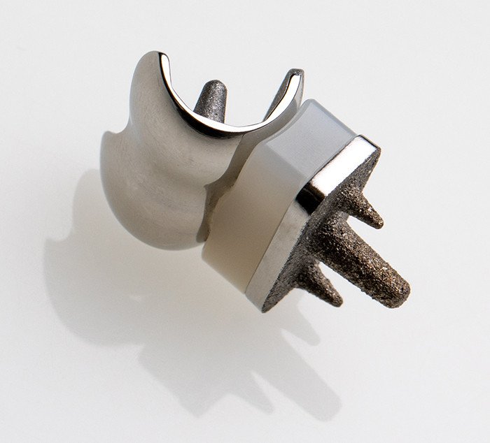 Prototyp der Fingermittelgelenkprothese (CapFlex-PIP)
