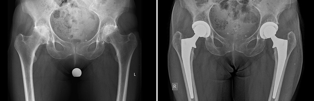 Fallbeispiele der operativen Behandlung der Hüftarthrose | Schulthess Klinik