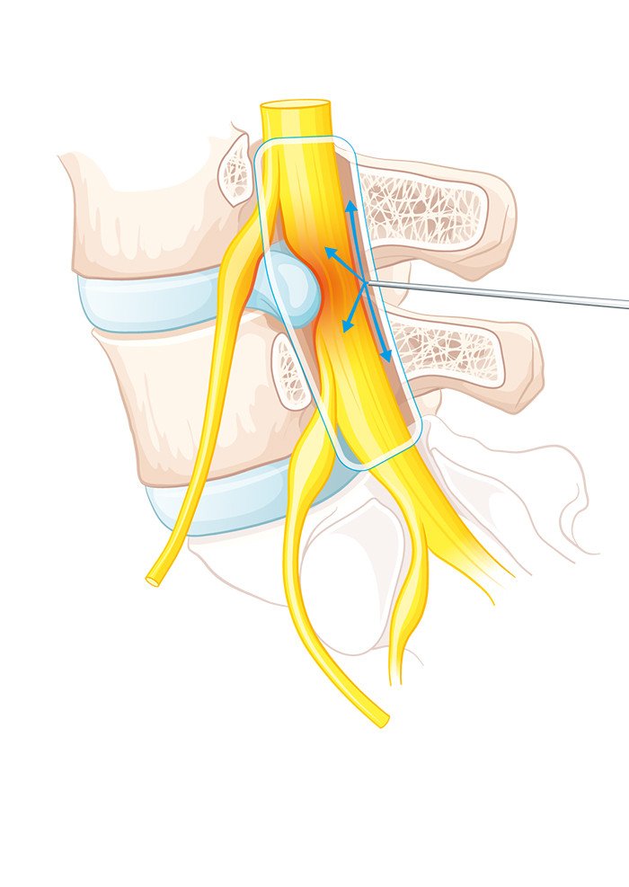 Epidurale interlaminäre Infiltration