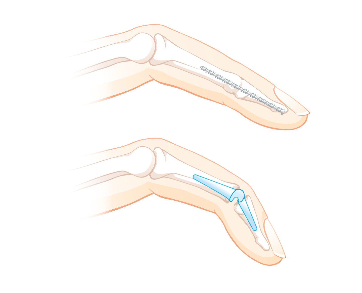 Behandlungsmöglichkeiten bei einer Arthrose des Fingerendgelenks
