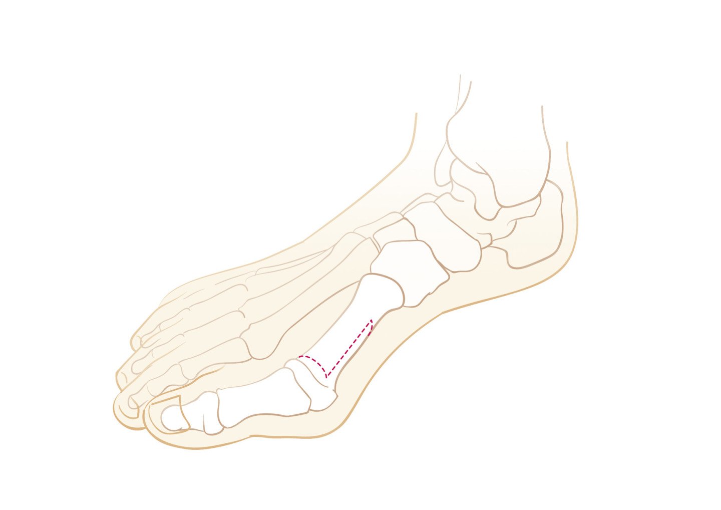 «Scarf»-Knochenschnitt Hallux Valgus
