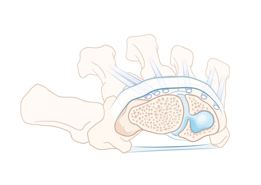 Ganglion mit Ursprung zwischen Kahn- und Mondbein
