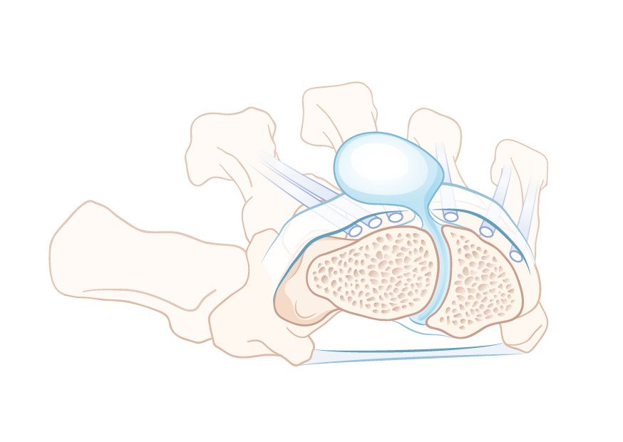 Ganglion mit Wachstum in den Knochen