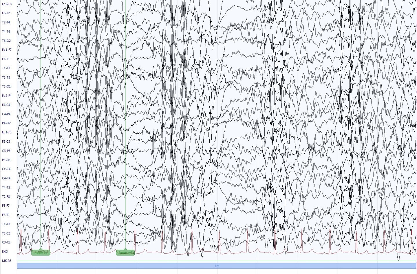 EEG bei juveniler Absence-Epilepsie während Hyperventilation