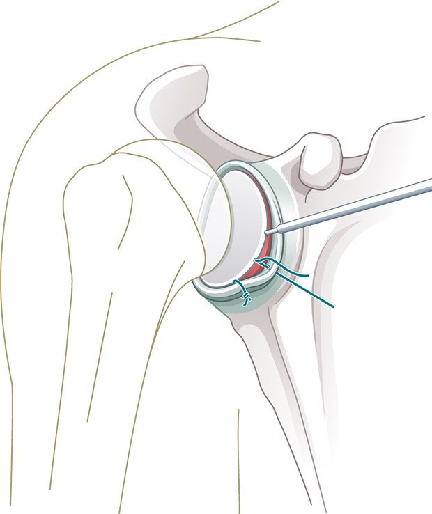 Schulterluxation: Einbringen der Knochenanker und Refixation der Gelenklippe