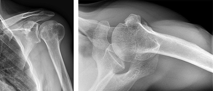 Oberarmbruch Schmerzen Nach 1 Jahr www.schulthess-klinik.ch