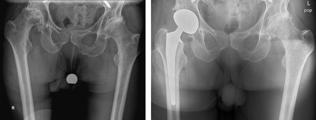 Röntgenbilder Hüftprothese bei Parkinson vor und nach OP