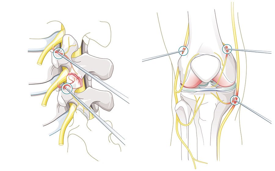 Illustration Thermoablation Wirbelsäule und Knie