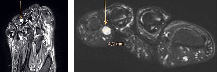 MRI-Bilder mit Schwannom (Tumor im Zeh)