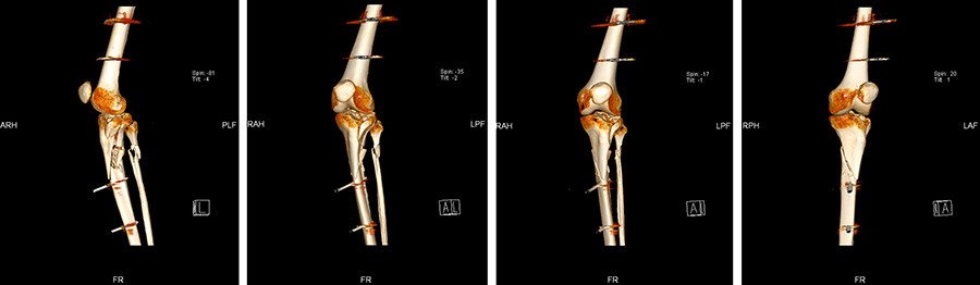 Präoperative 3D-CT-Bilder der Tibiakopffraktur