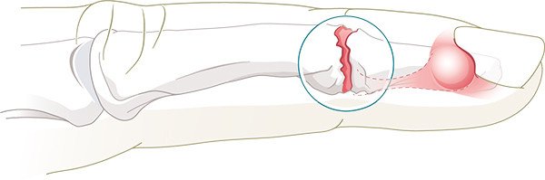 Arthrose des Fingerendgelenks mit Zyste