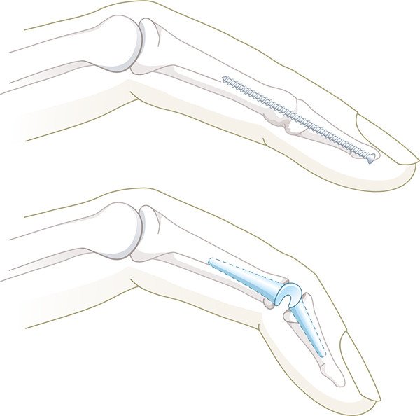 Behandlungsmöglichkeiten bei einer Arthrose des Fingerendgelenks