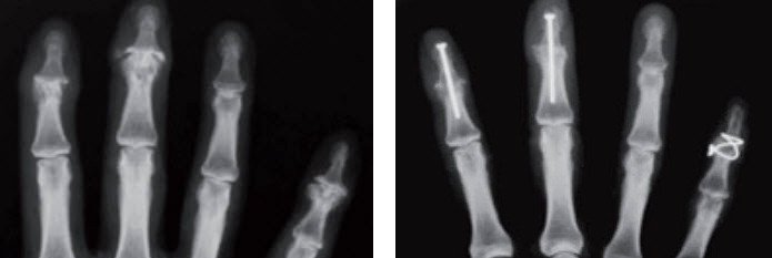 Röntgenbild Arthrosen der Endgelenke und Befund nach operativer Versteifung