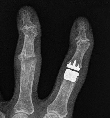 Röntgenbild nach Einsetzen einer Silikonprothese und eines anatomischen Oberflächenersatzes