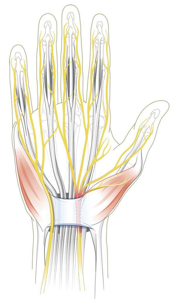 Karpaltunnelsyndrom oder Carpal-Tunnel-Syndrom mit Nervus Meridianus