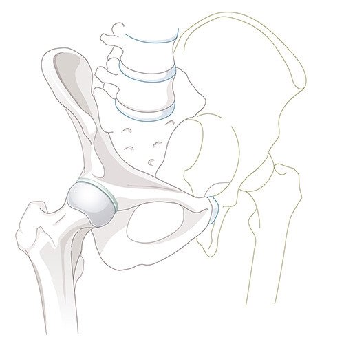 Illustration Hüftdysplasie