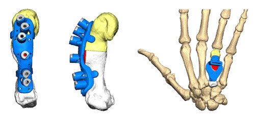 3D-Simulation: Planung Korrektur Hand mit Säge- und Bohrhilfen