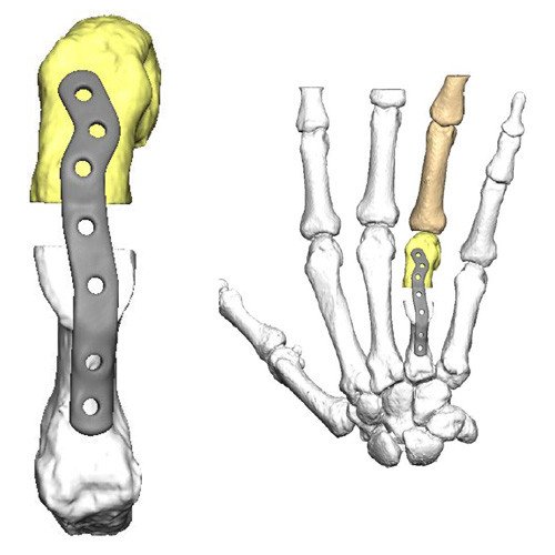 3D-Simulation: Korrektur mit Verlängerung Handknochen gedruckter Titanplatte