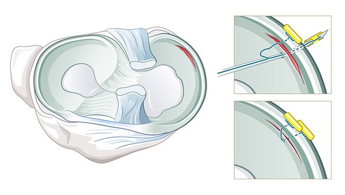 Illustration Operation Meniskusnaht