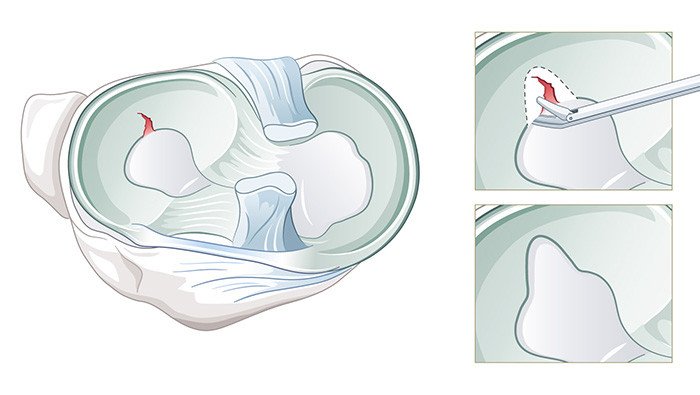 Illustration Operation Meniskusteilresektion