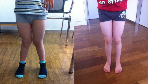 Foto Kind mit Verlauf Entwicklung X-Beine