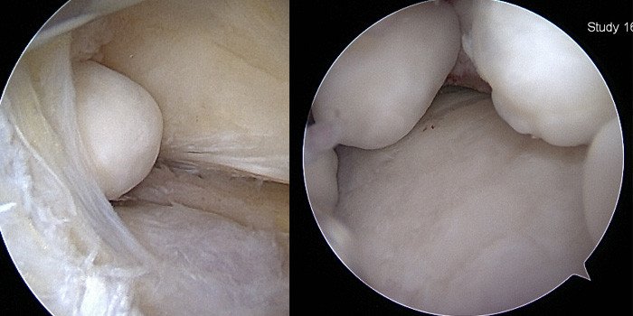 Chondromatose Abbildung 6 und 7