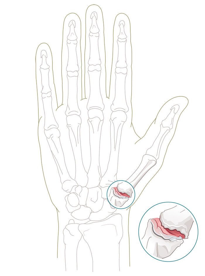 Illustration Daumensattelgelenk mit Arthrose