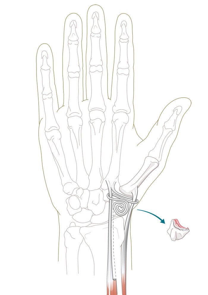 Illustration Operation bei fortgeschrittener Daumensattelgelenksarthrose