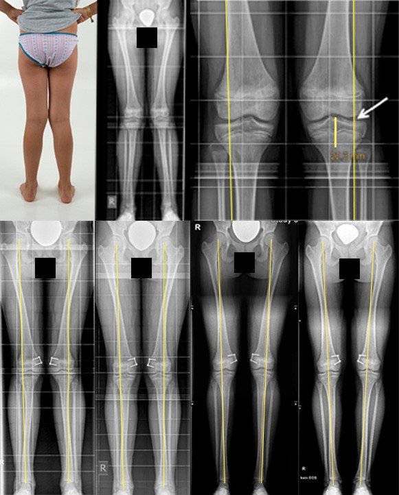 Foto und Röntgenbilder Verlauf Behandlung X-Beine