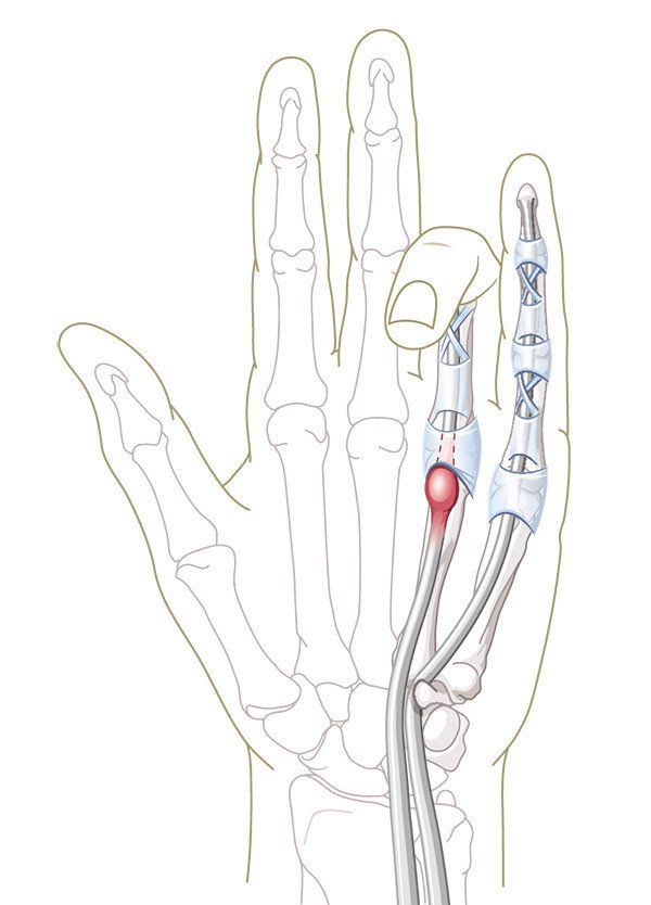 Schnellender Finger