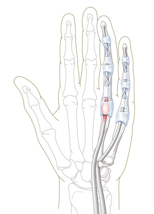 Schnellender Finger