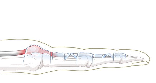 Schnellender Finger Sehnenknoten
