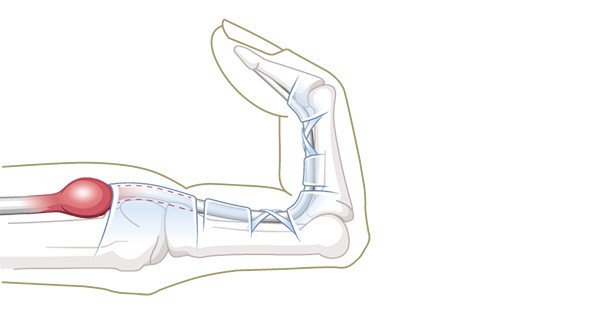 Schnellender Finger Sehnenknoten