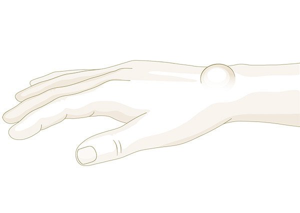Weiches Überbein (Ganglion) am Handgelenk