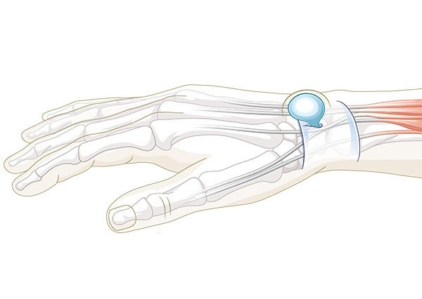 Weiches Überbein (Ganglion) am Handgelenk