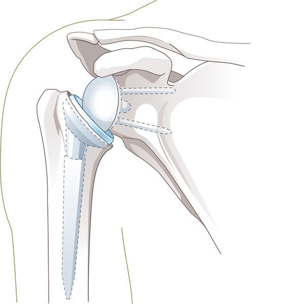 Illustration inverse Schulterprothese