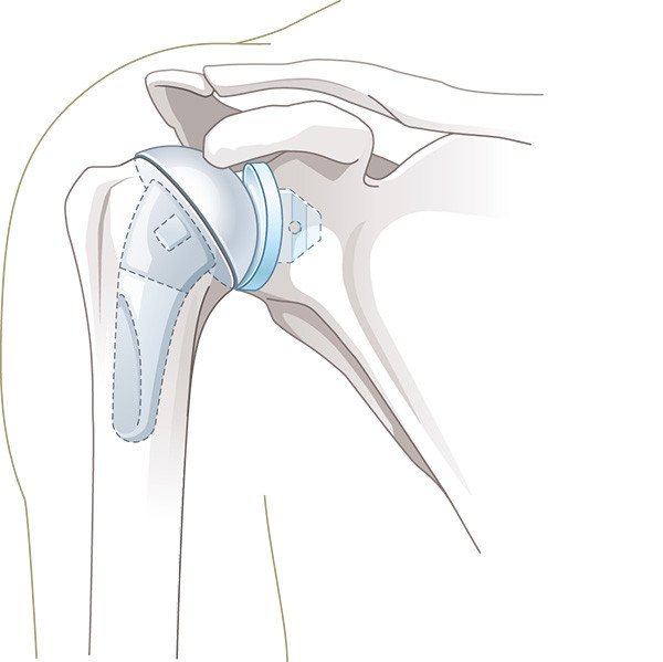 Illustration Schulterprothese