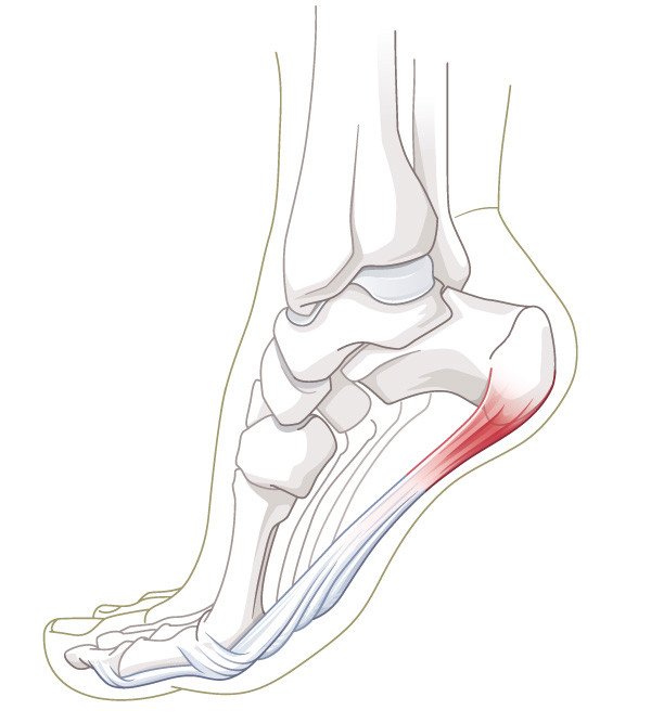 Plantaraponeurose Fersenschmerz