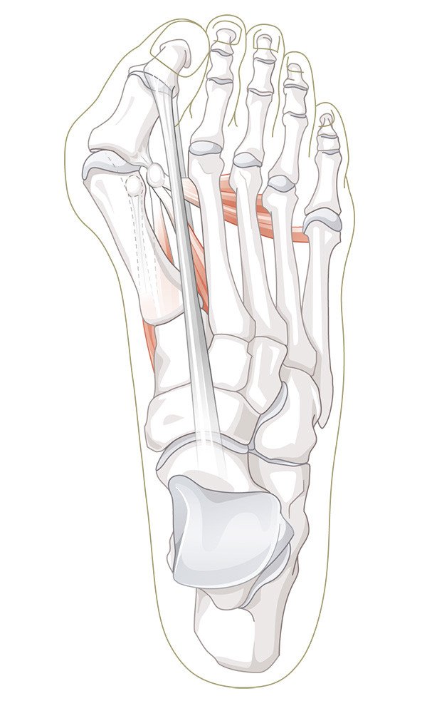 Hallux Valgus