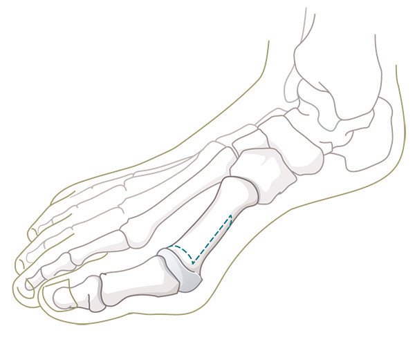 «Scarf»-Knochenschnitt Hallux Valgus