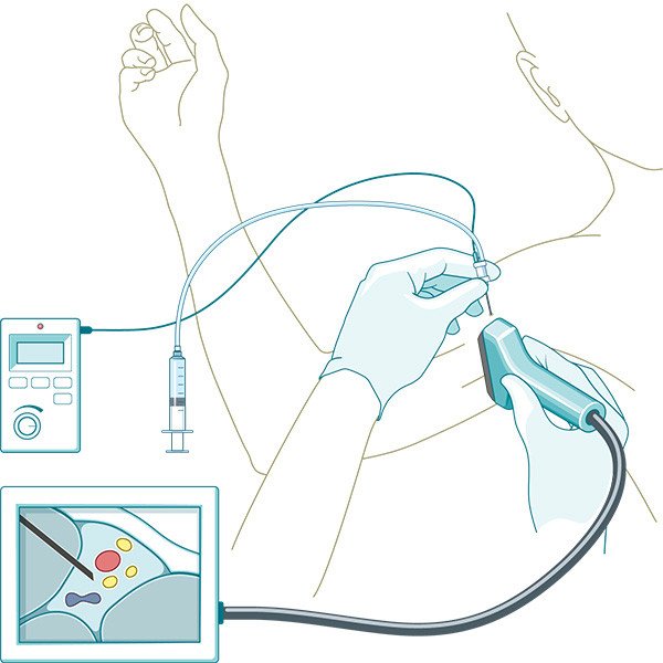 Anaesthesie_Ultraschallgesteuerte_Regionalanästhesie