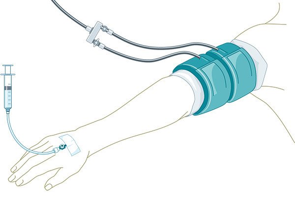 Anaesthesie_5_Intravenöse_Regionalanästhesie