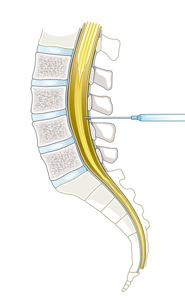 Anaesthesie_6_Spinalanästhesie