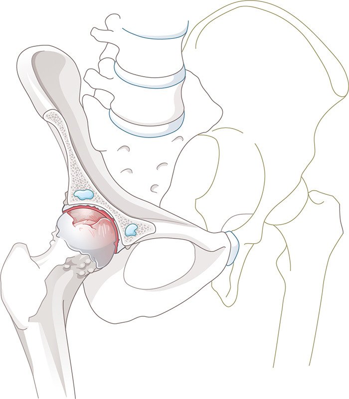Illustration Hüftarthrose mit Zysten