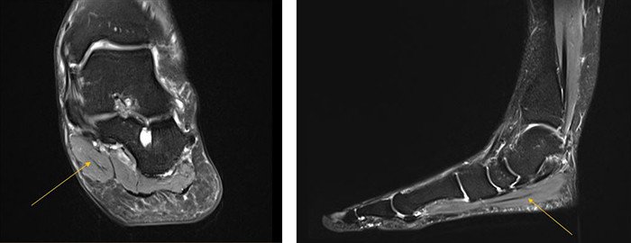 2 MRI-Bilder des Musculus abductor hallucis
