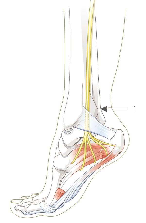 Nervus tibialis mit seinen Ästen zur Fusssohle