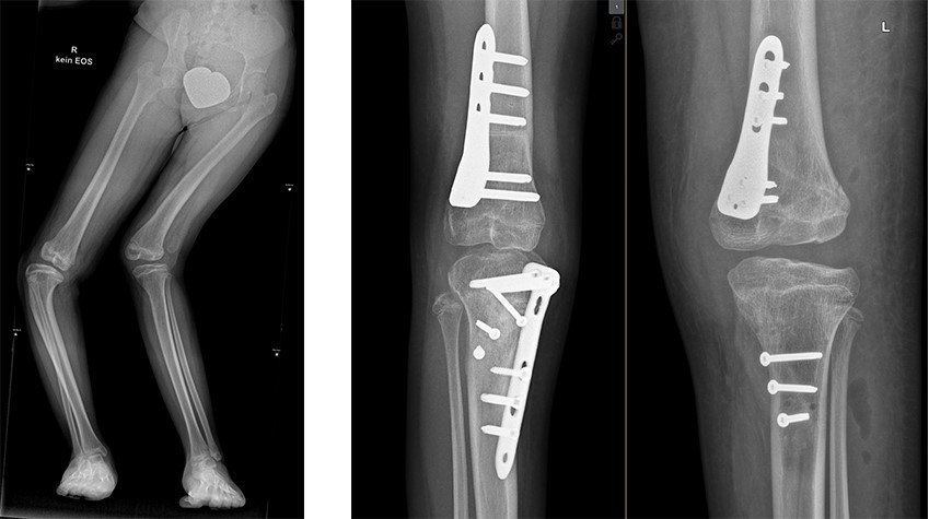 Patientenhilfsfonds: Mara geht ihren Weg | Schulthess Klinik